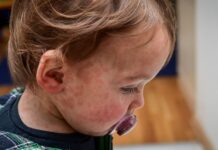 UK Reverts to Measles Endemicity: A Decade of Declining Immunity