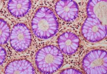 Старіння кишечника та рак: нові дані про підвищення ризику колоректального раку