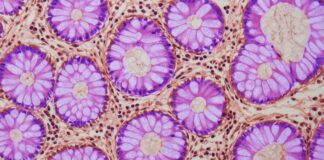 Старение кишечника и рак: новые данные о росте риска колоректального рака